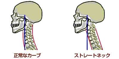 ストレートネックとは？整骨院での治療と原因を解説！